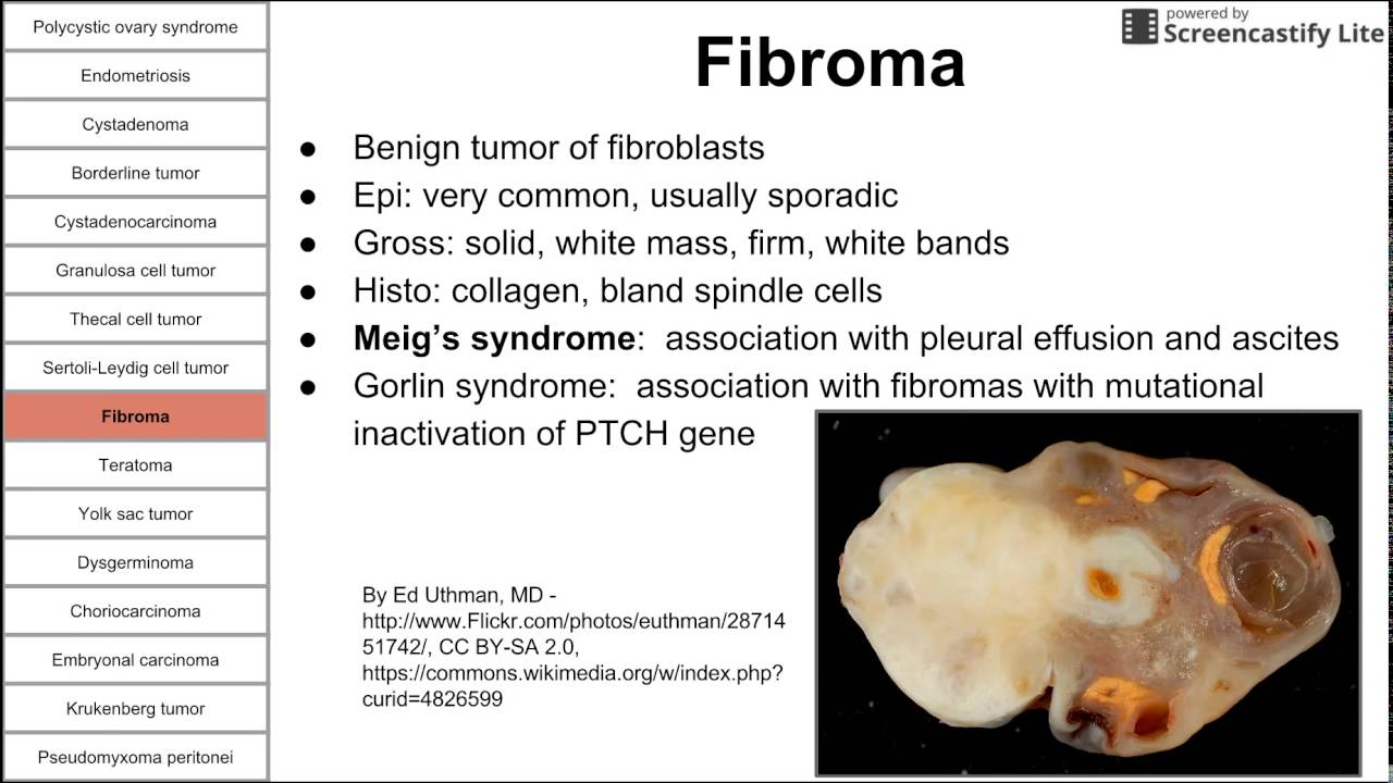 Ovarian pathology