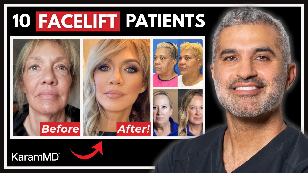 10 Real Facelift Results That Look Natural - Facial Rejuvenation Before & After
