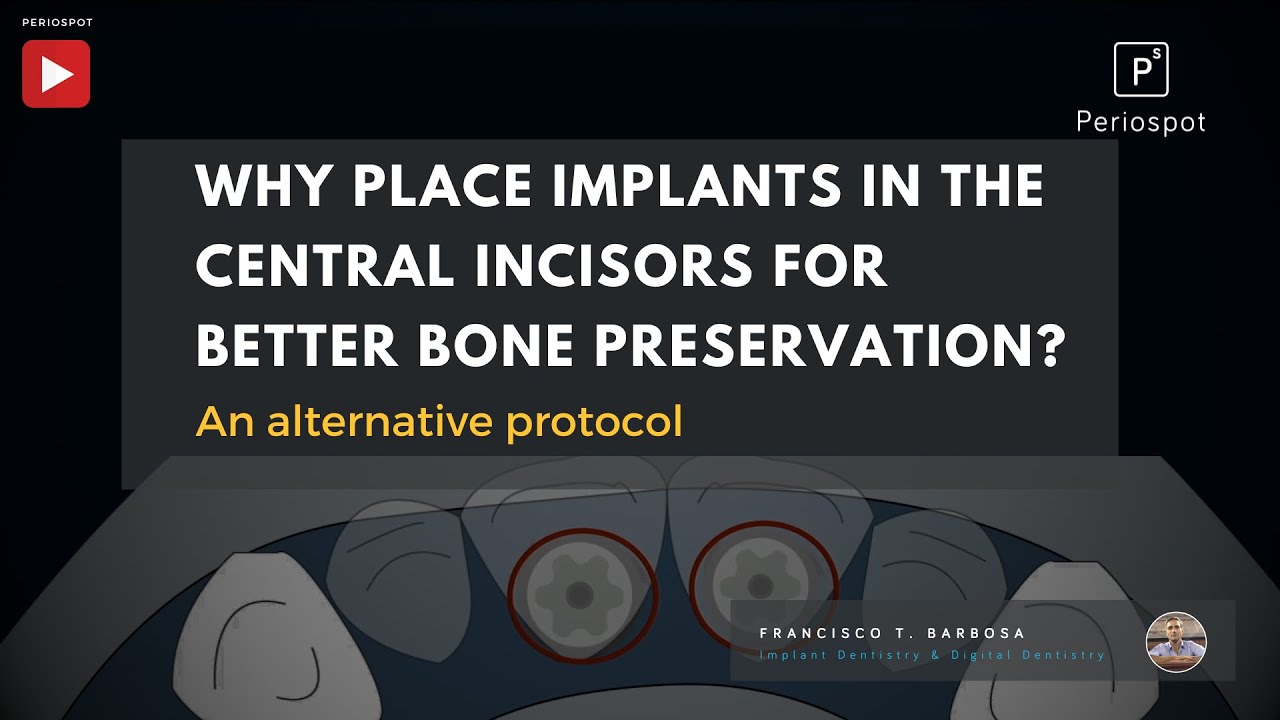 Why Place Implants in the Central Incisors for Better Bone Preservation?