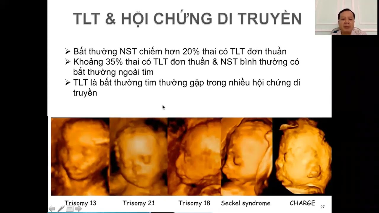 30 Các bệnh tim bẩm sinh thường gặp trong bào thai - TS.BS. Lê Kim Tuyến