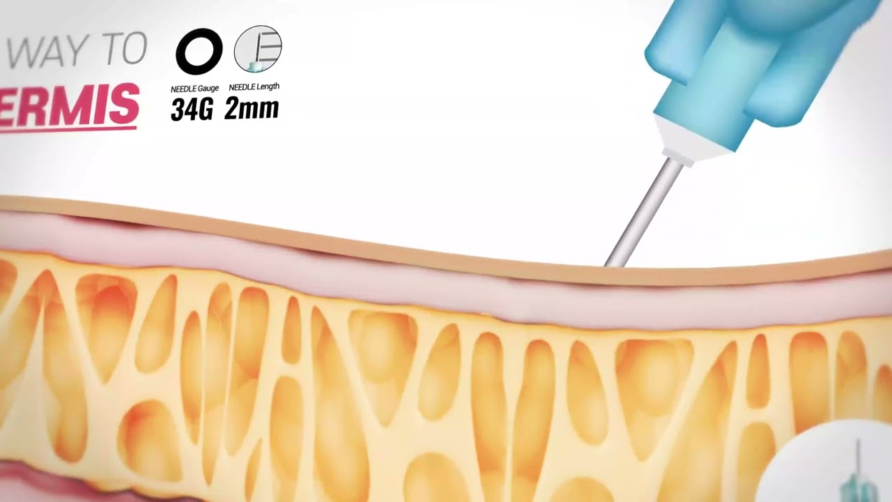 234-NEEDLEs : The easiest way to target DERMIS