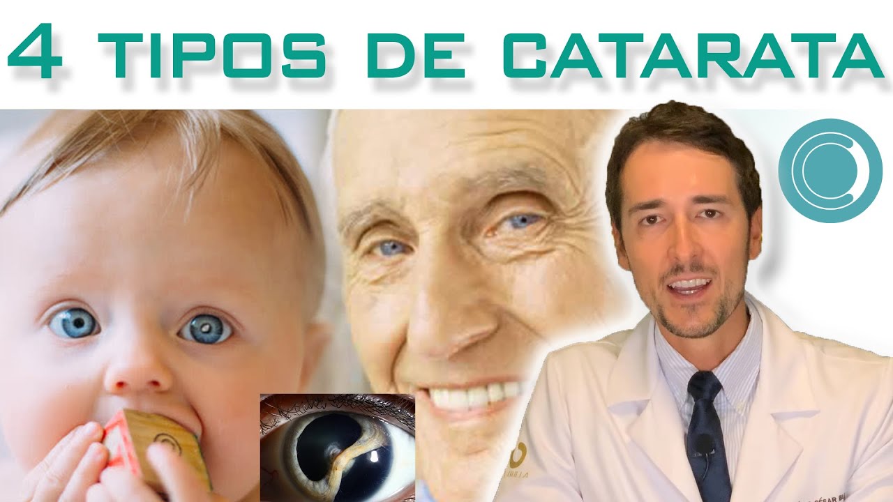 Catarata no olho - todo tipo precisa cirurgia?