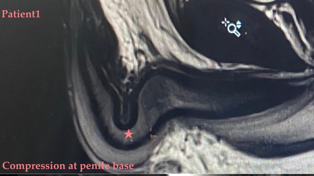 My Hard Flaccid Story (Symptoms, Timeline, Recovery)