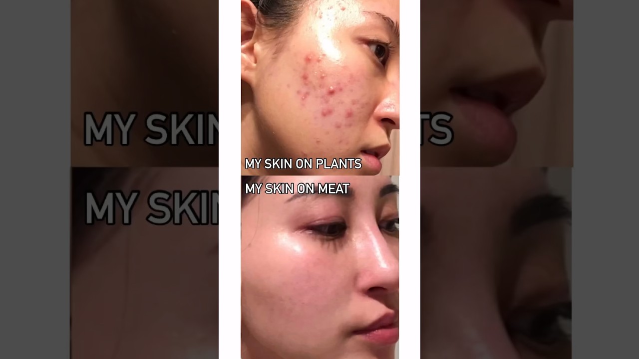 CARNIVORE TO VEGAN SKIN TRANSFORMATION!