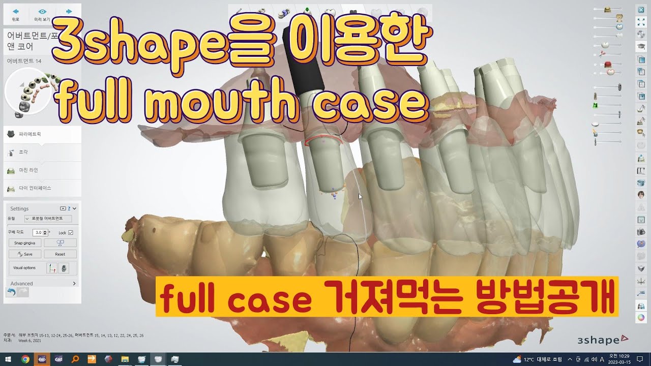 치과에서 oral scan과 face scan을 이용하여 의뢰하였고 3shape으로 custom abutment제작과정입니다. 중간중간 고급설명 들어갑니다.