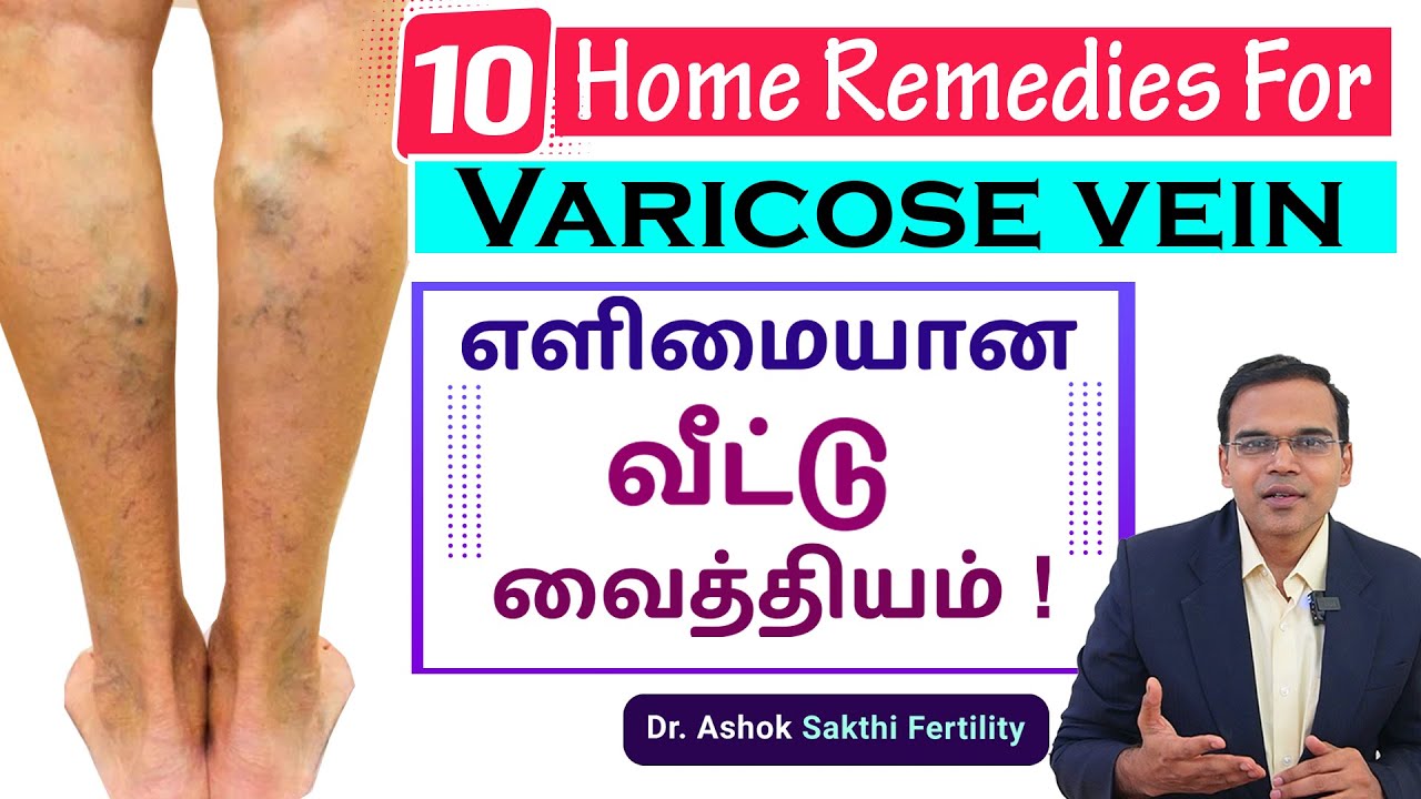 10 Home Remedies For Varicose Vein !! 10 எளிமையான இயற்கை வீட்டு வைத்தியம் !! -  Dr. Ashok