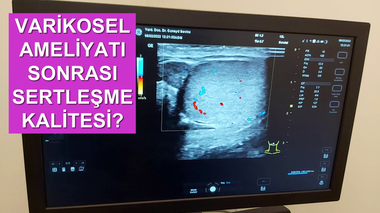 Varikosel Sertleşmeyi Engeller mi? Varikosel Ameliyatı Sonrası Cinsel Fonksiyonlarda Artış