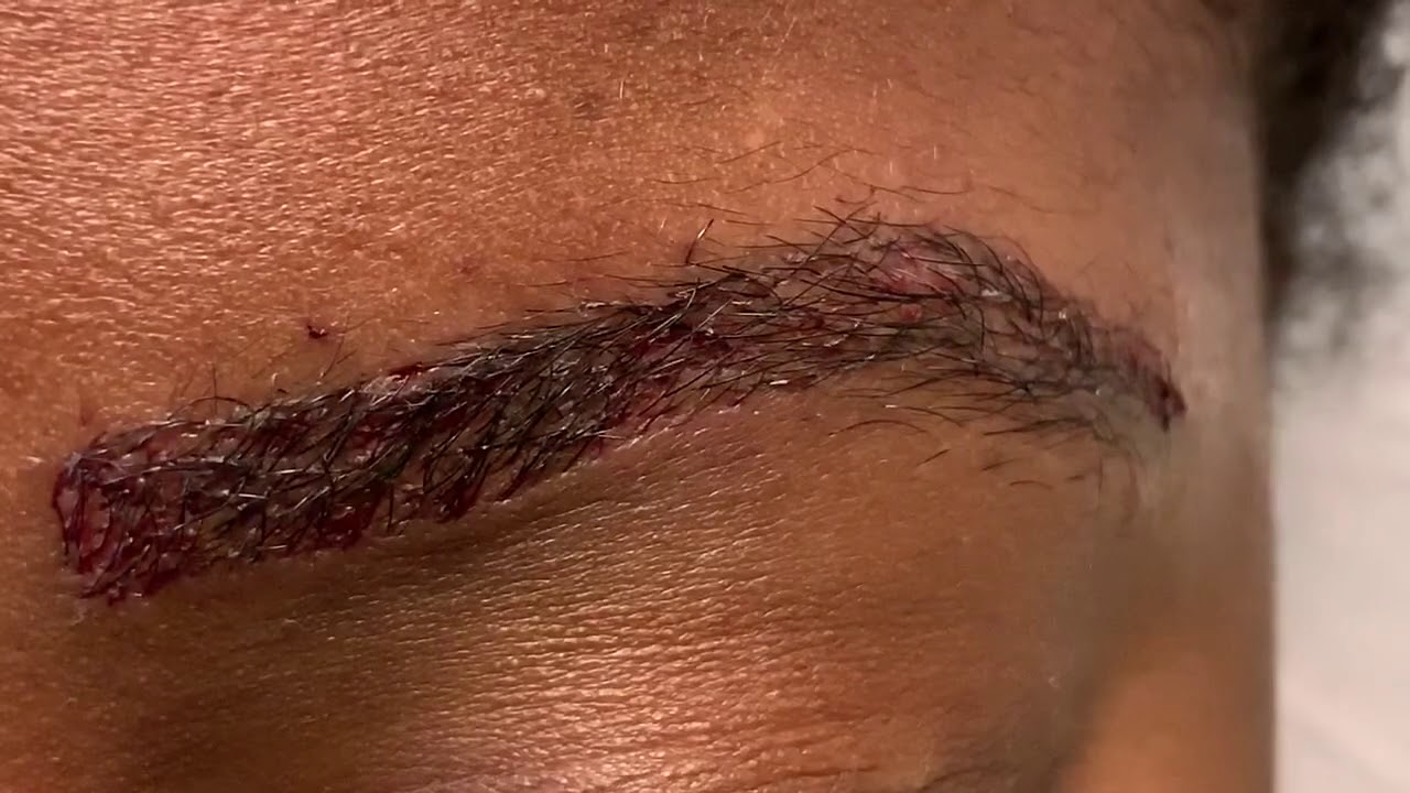 Dallas African-American Eyebrow Transplant Closeup Immediately After