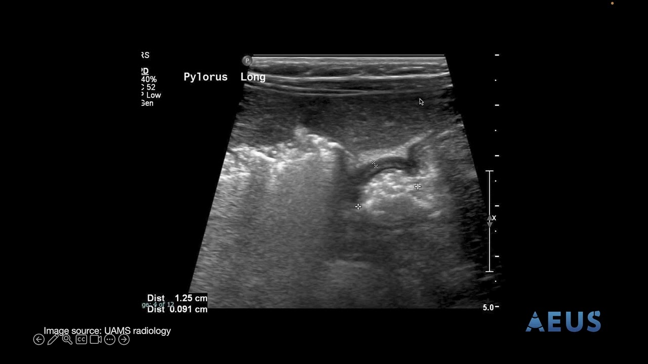 AEUS Narrated Lecture Series: Pyloric Stenosis