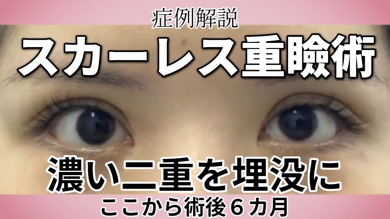 症例解説、スカーレス重瞼術で、濃い二重瞼を二重埋没に変えました。手術後６カ月