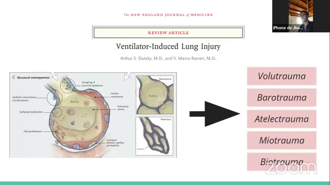 VENTILACIÓN MECÁNICA EN ECMO