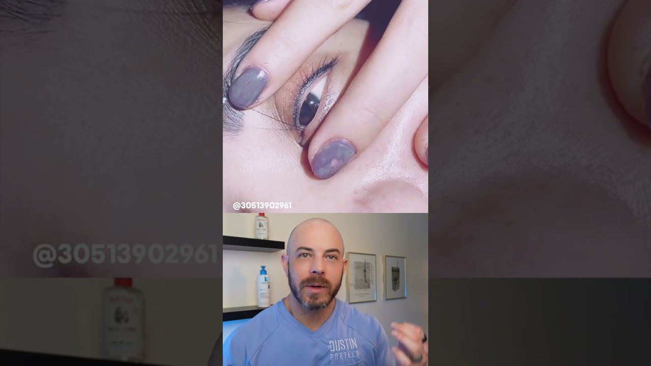 Extra-long eyelash?! #ingrownhair #dermreacts #doctorreacts