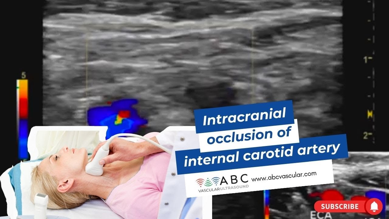 Intracranial occlusion of the internal carotid artery | Ultrasound
