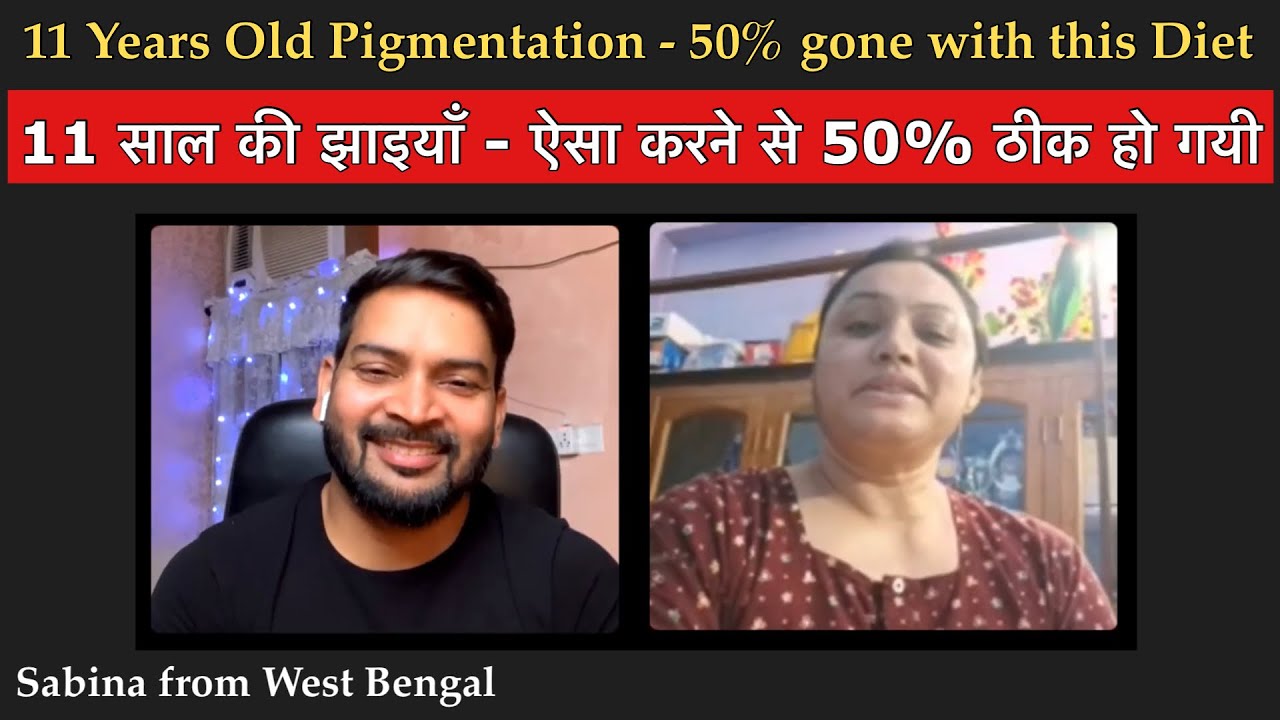 11 साल की झाइयाँ - ऐसा करने से 50% ठीक हो गयी I 11 year old Pigmentation - 50% gone with this Diet
