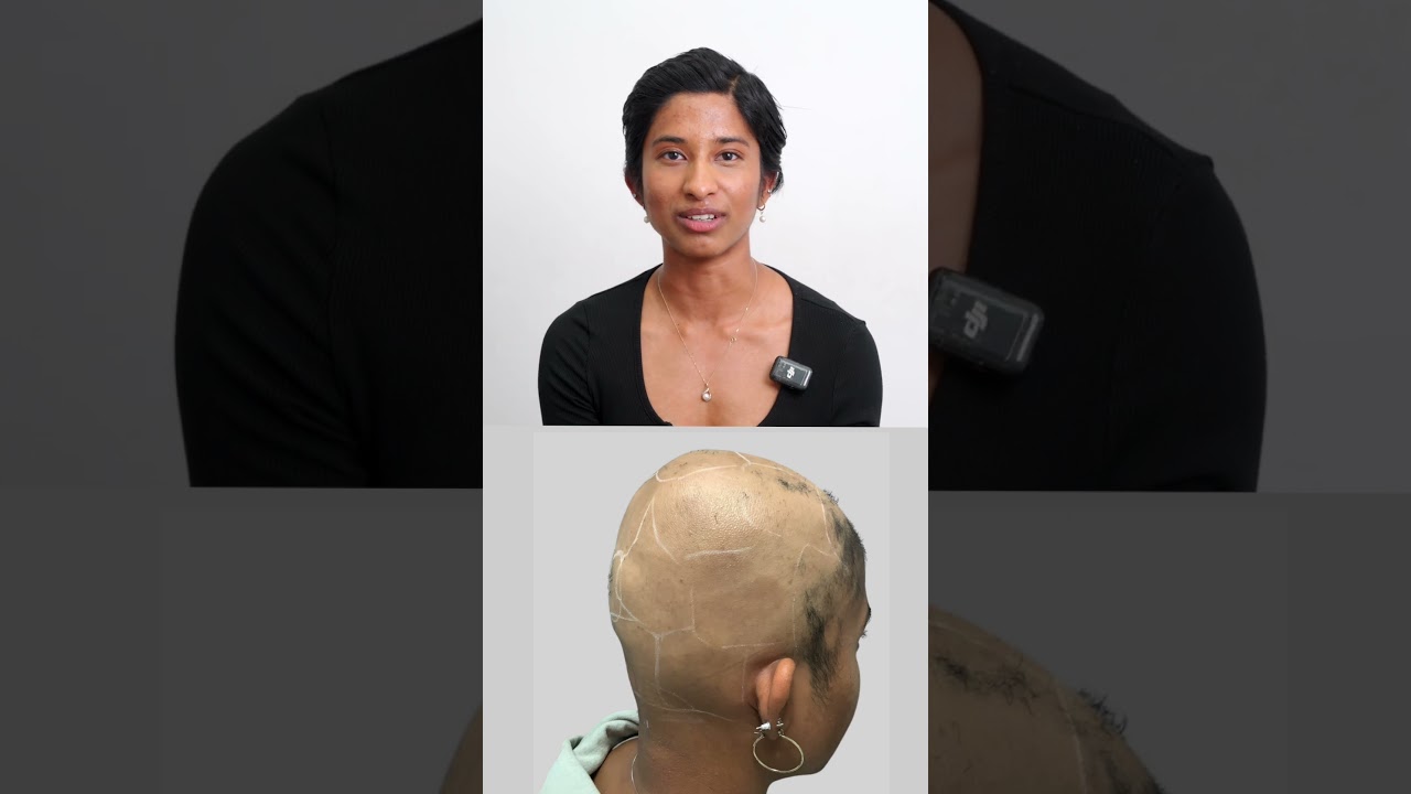 From Hair Loss to Hope | Paravi&rsquo;s Alopecia Recovery with Este Medical Group