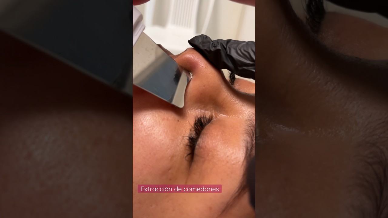 Extracci&oacute;n #cosmetology #limpiezafacial #microdermoabrasion #pielsana #granos #extraccion