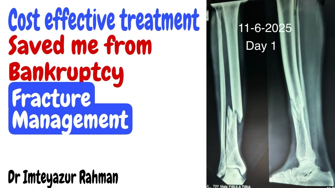 Cost effective fracture treatment of Tibia Fibula (lower leg)
