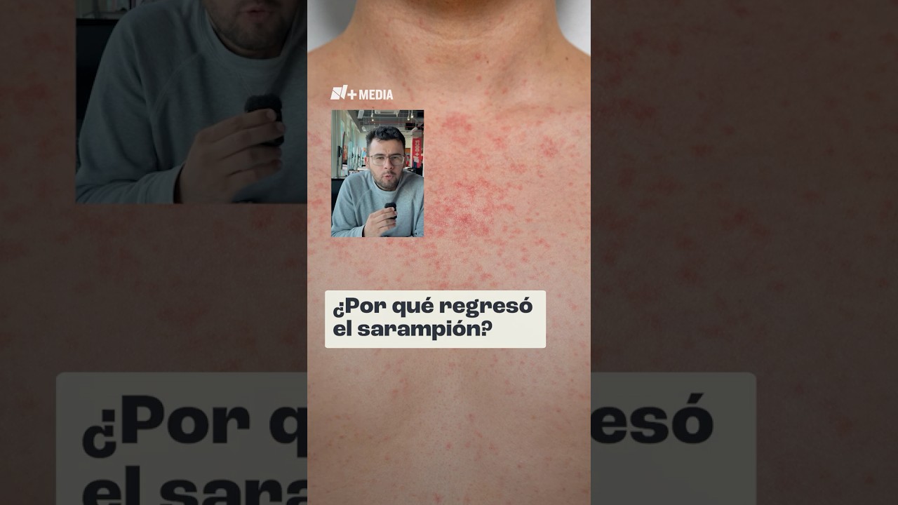 &iquest;Por qu&eacute; regres&oacute; el sarampi&oacute;n?