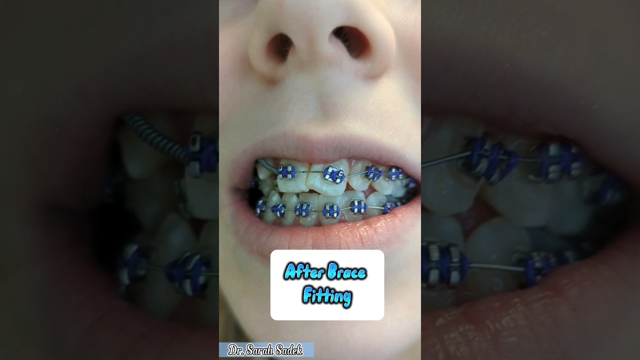 Before and After Brace Fitting Appointment #shorts #braces