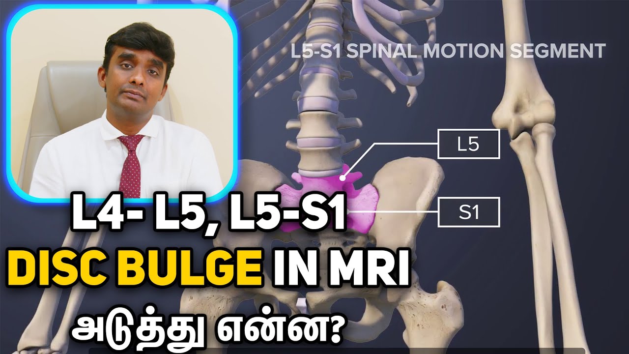 L4- L5, L5-S1 Disc Bulge in MRI அடுத்து என்ன?