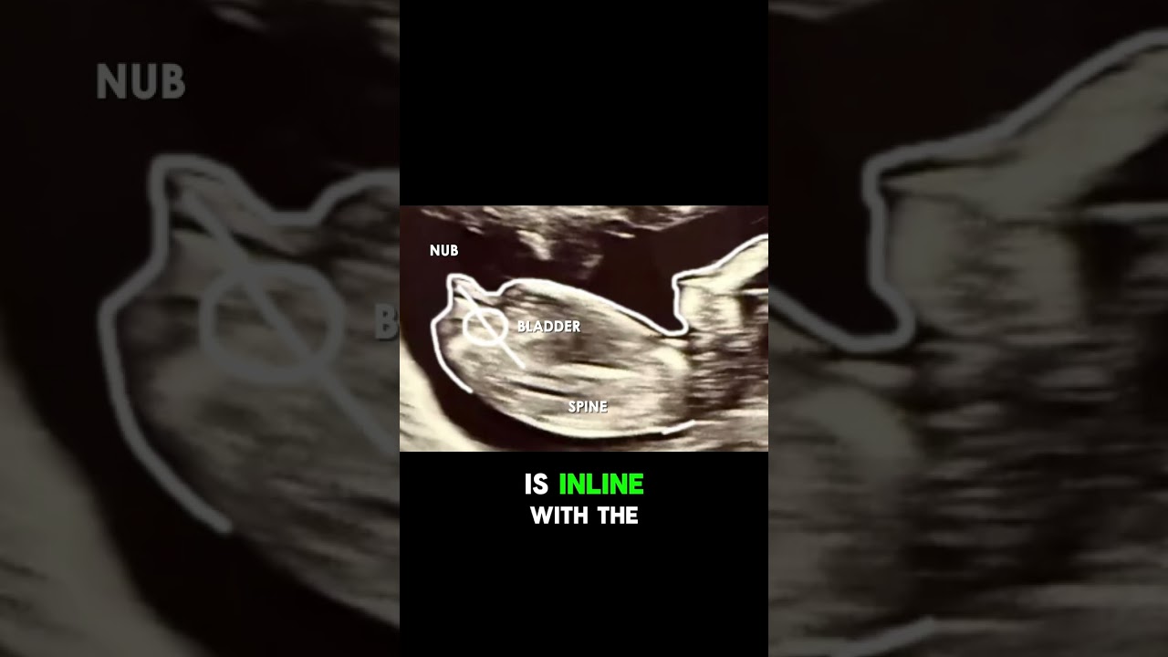 Did you predict this baby's gender correctly?