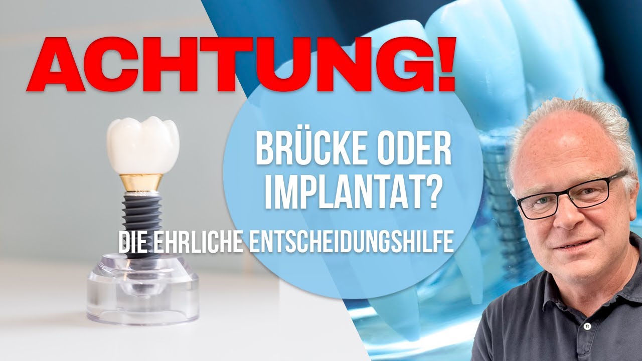 Brücke oder Implantat - Die ehrliche Entscheidungshilfe von Dr. Szostak