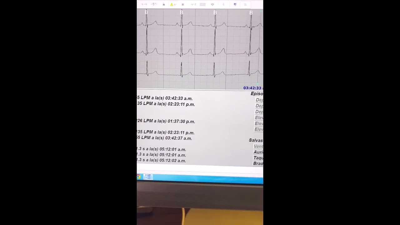 Holter, diagnóstico de arritmias y tratamiento individualizado