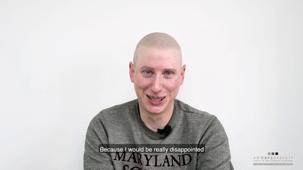 Scalp Micropigmentation vs Tricopigmentation regarding Alopecia Universalis? Morgan's testimonial.