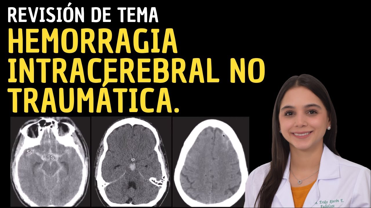 Revisión de Tema 44: Hemorragia Intracerebral No Traumática.