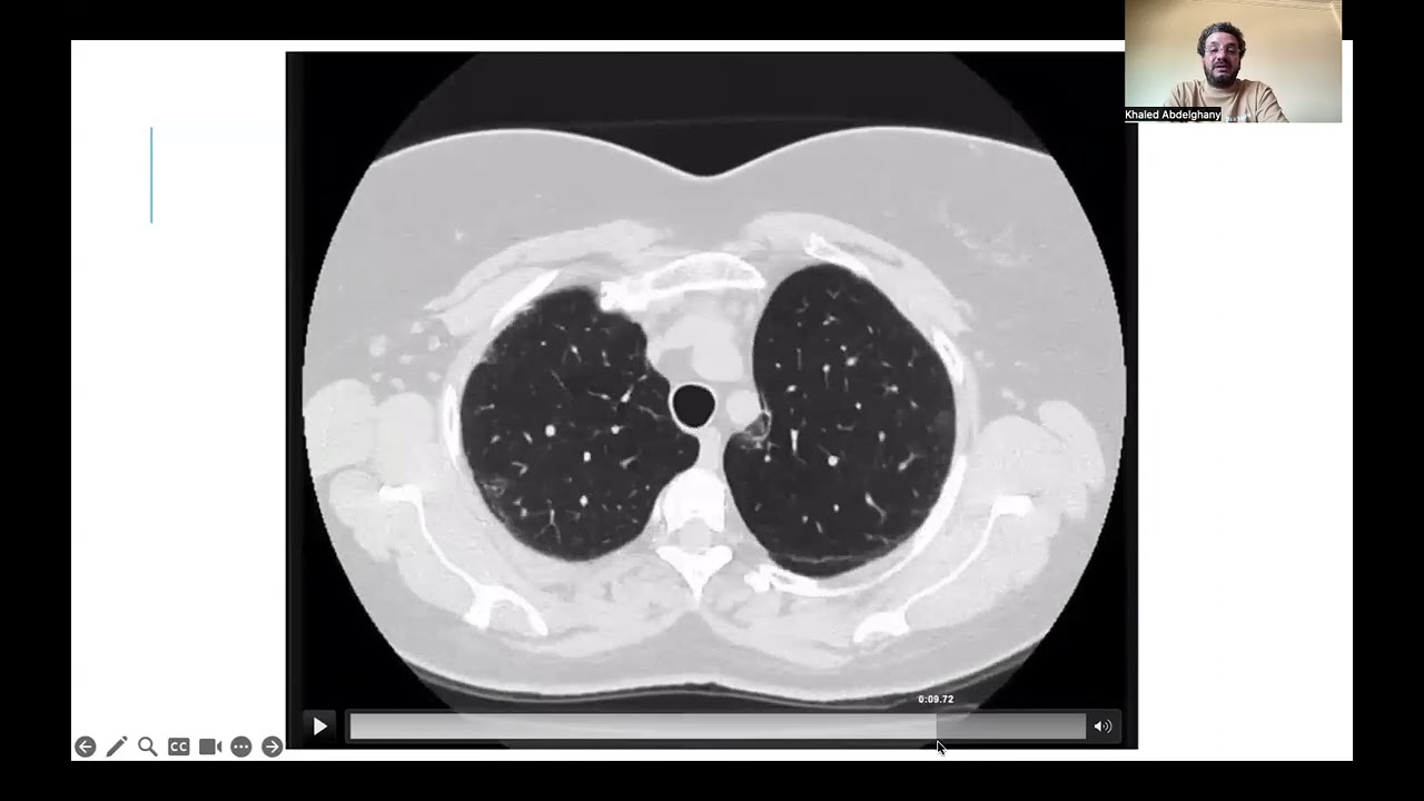 What do you need to diagnose NSIP in HRCT