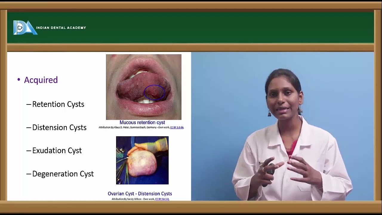 Cysts | General surgery for Dentists | #NEET#MDS#BDS#NBDE#ORE#DDS