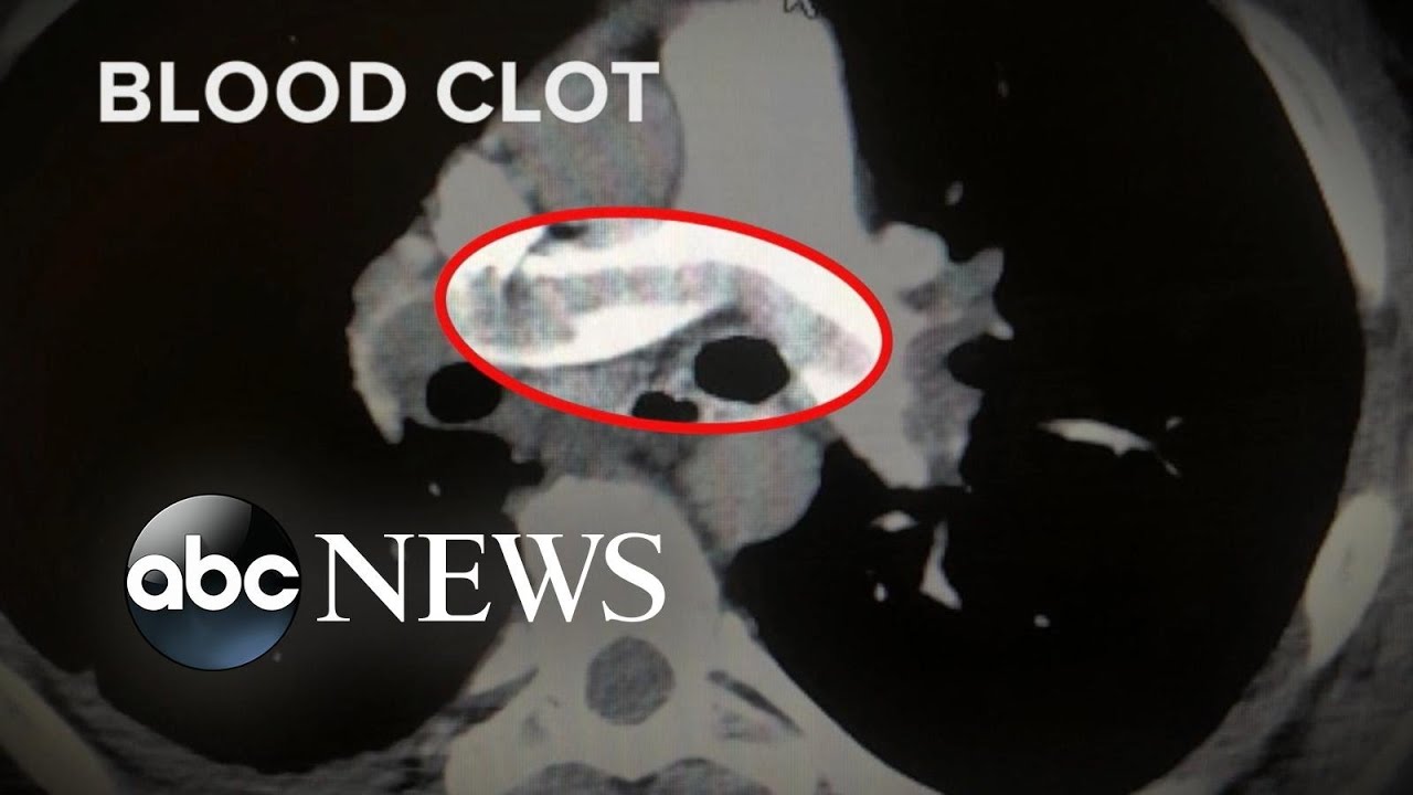 High number of COVID-19 patients have blood clots | WNT