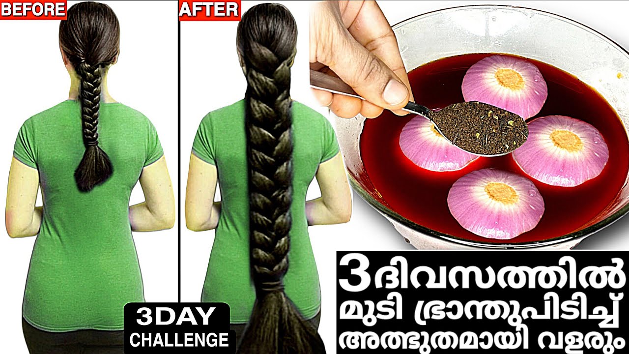 10രൂപയിൽ,3ദിവസത്തിൽ മുടി ഭ്രാന്തുപിടിച്ചു വളരും അത്ഭുതകരമായ രഹസ്യം!