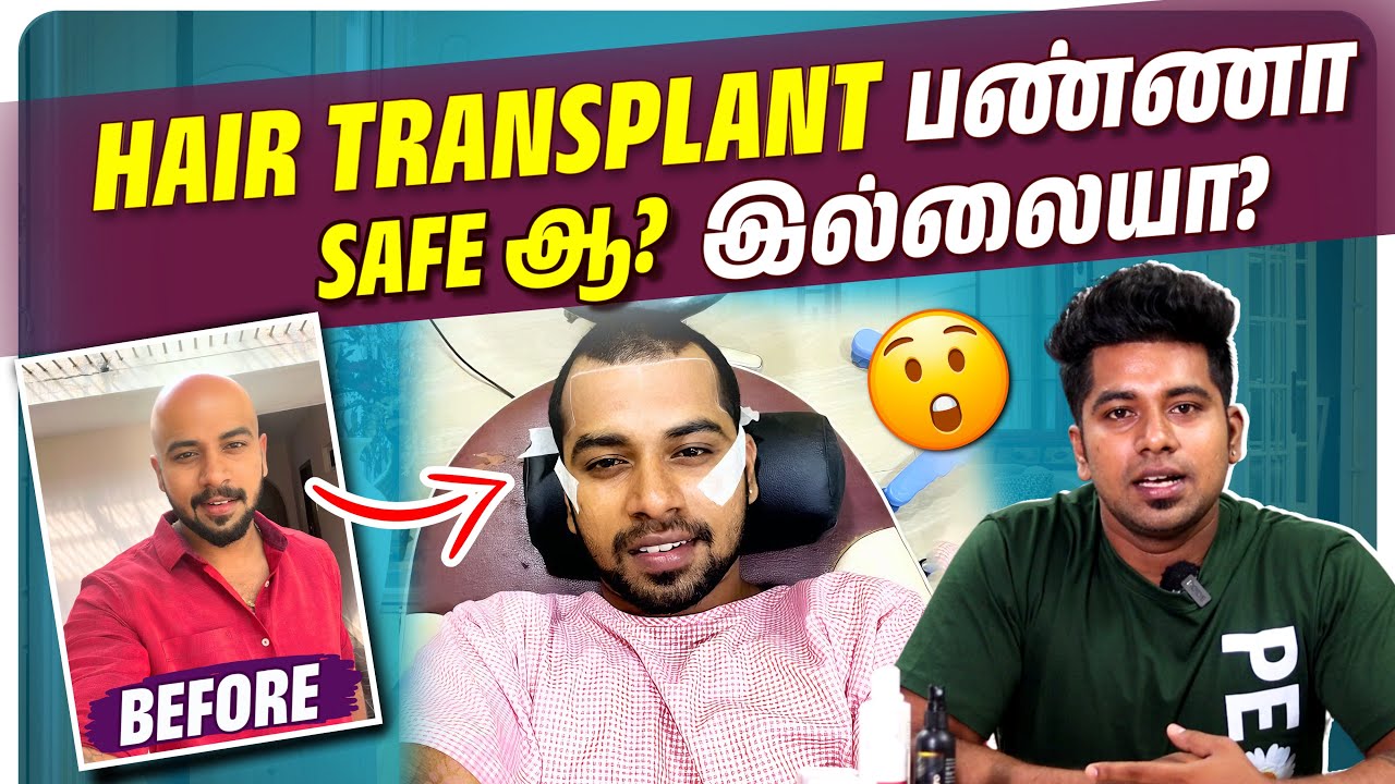 My HAIR TRANSPLANT RECENT UPDATE😱😱watch till the end🤩🤩|| JUUJEE VLOGS ||