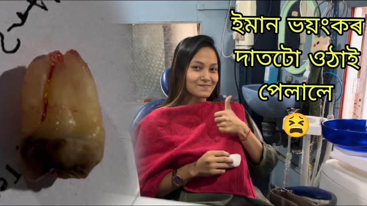 মোৰ দাতৰ চিকিৎস্যা সম্পূৰ্ণ হ’ল😩 মানুহজনে ৰখিব আহি আমিহে ৰখীয়া হ’লো🥲 