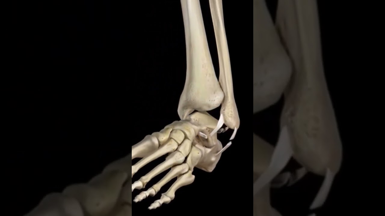 tor&ccedil;&atilde;o de tornozelo, veja o v&iacute;deo na &iacute;ntegra para saber o que fazer! #ortopediaetraumatologia
