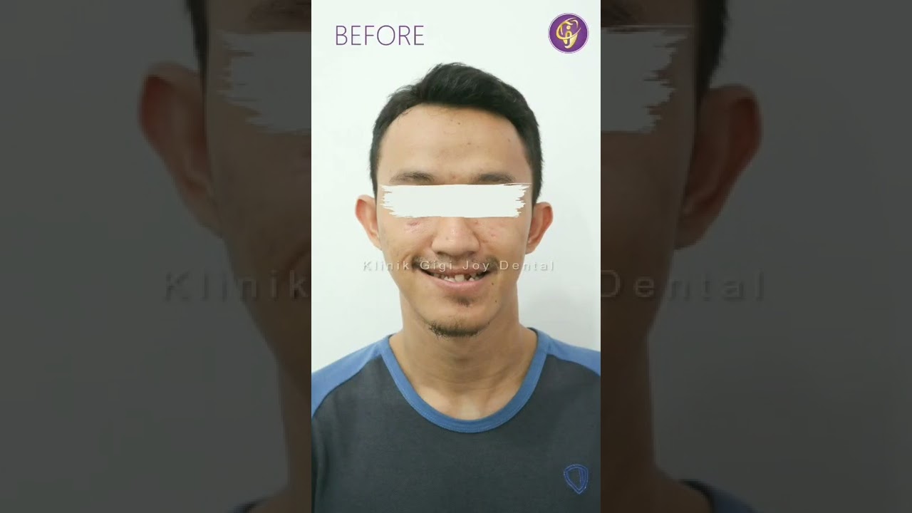 BEFORE AFTER PERAWATAN BEHEL UNTUK ORANG DEWASA #shorts