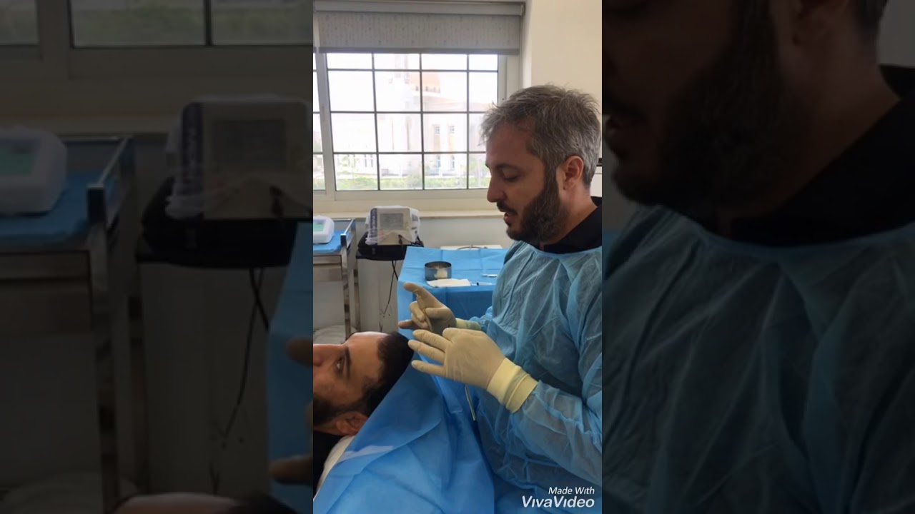 Follow up after doing biofiber with dr.basem زراعة الشعر بطريقة البيوفايبر مع د. باسم الحلبي