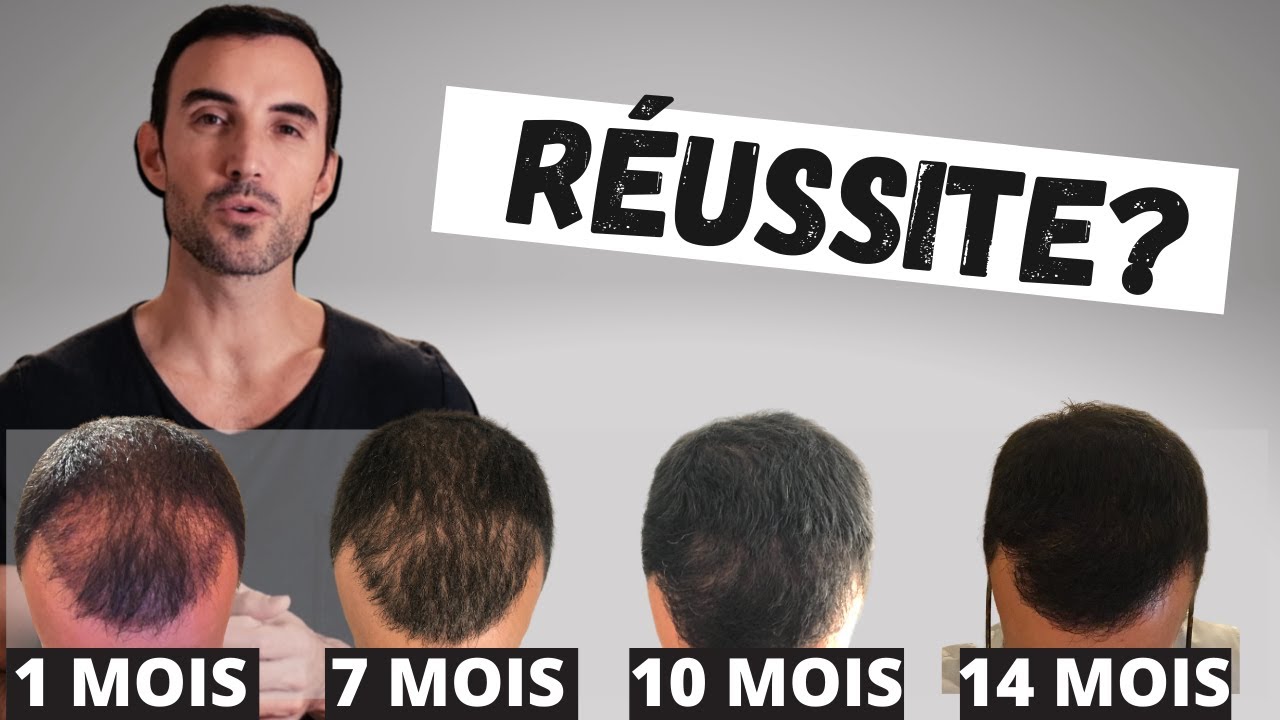 Ma Greffe de Cheveux Est-elle RÉUSSIE 🥳 ou PAS 😢 ?
