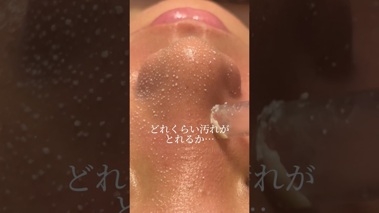 【韓国式3D毛穴洗浄】 どれくらい汚れがとれるか&hellip; #毛穴洗浄 #美容