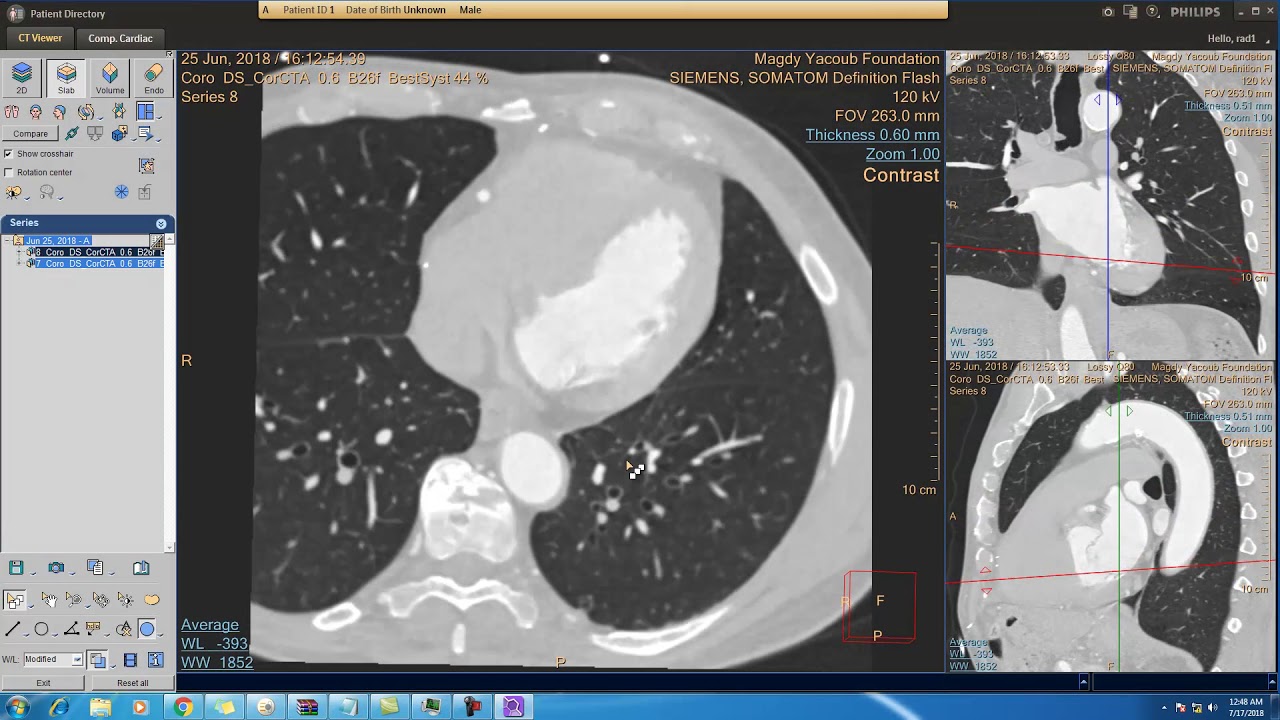 Philips portal CT Viewer & cardiac CT viewer introduction 50 minutes