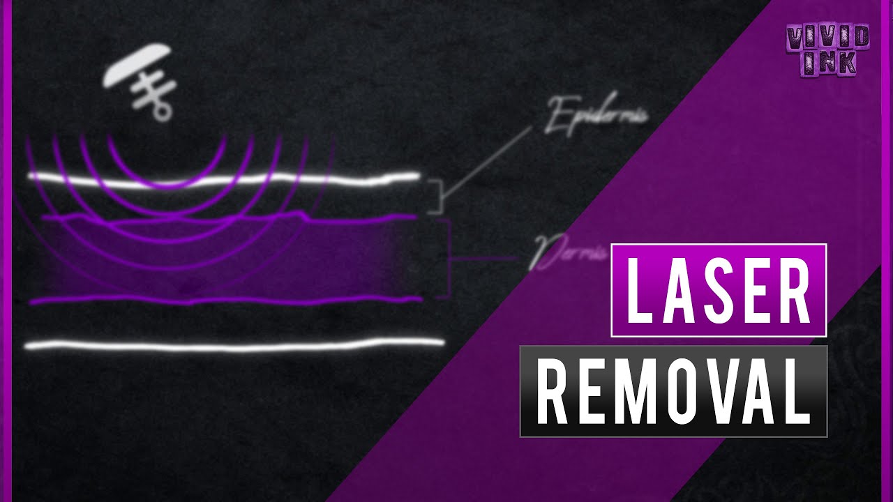 Laser tattoo removal and the full process, Everything you need to know, the results and FAQ