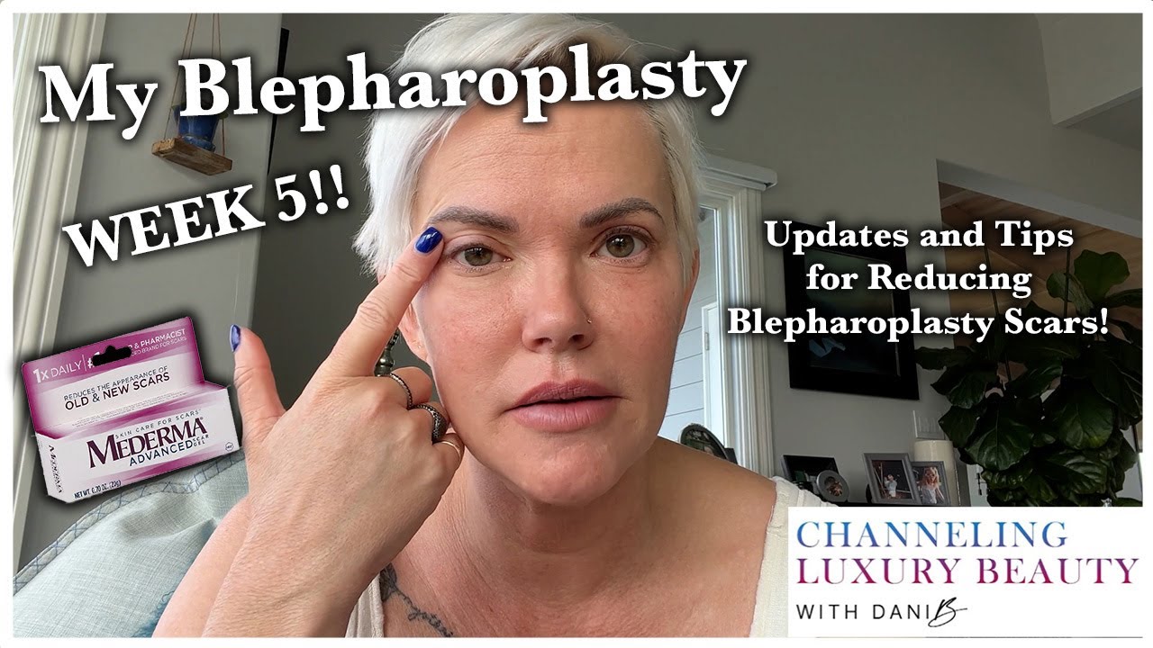 Blepharoplasty Update Week 5! Scars, Recovery, Bruising, Update Eyelid Surgery! CO2 Laser & Scar Gel