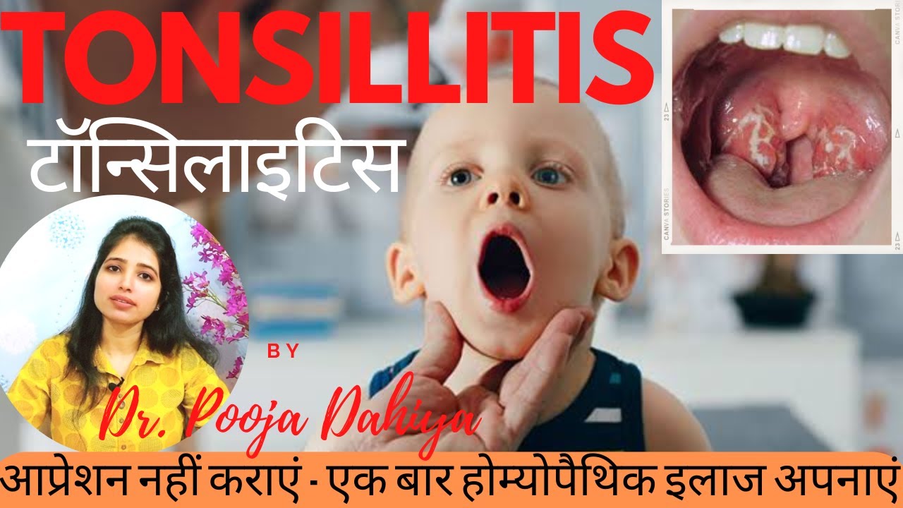 Tonsillitis treatment in Homeopathy | recurrent tonsillitis in children | treatment without surgery
