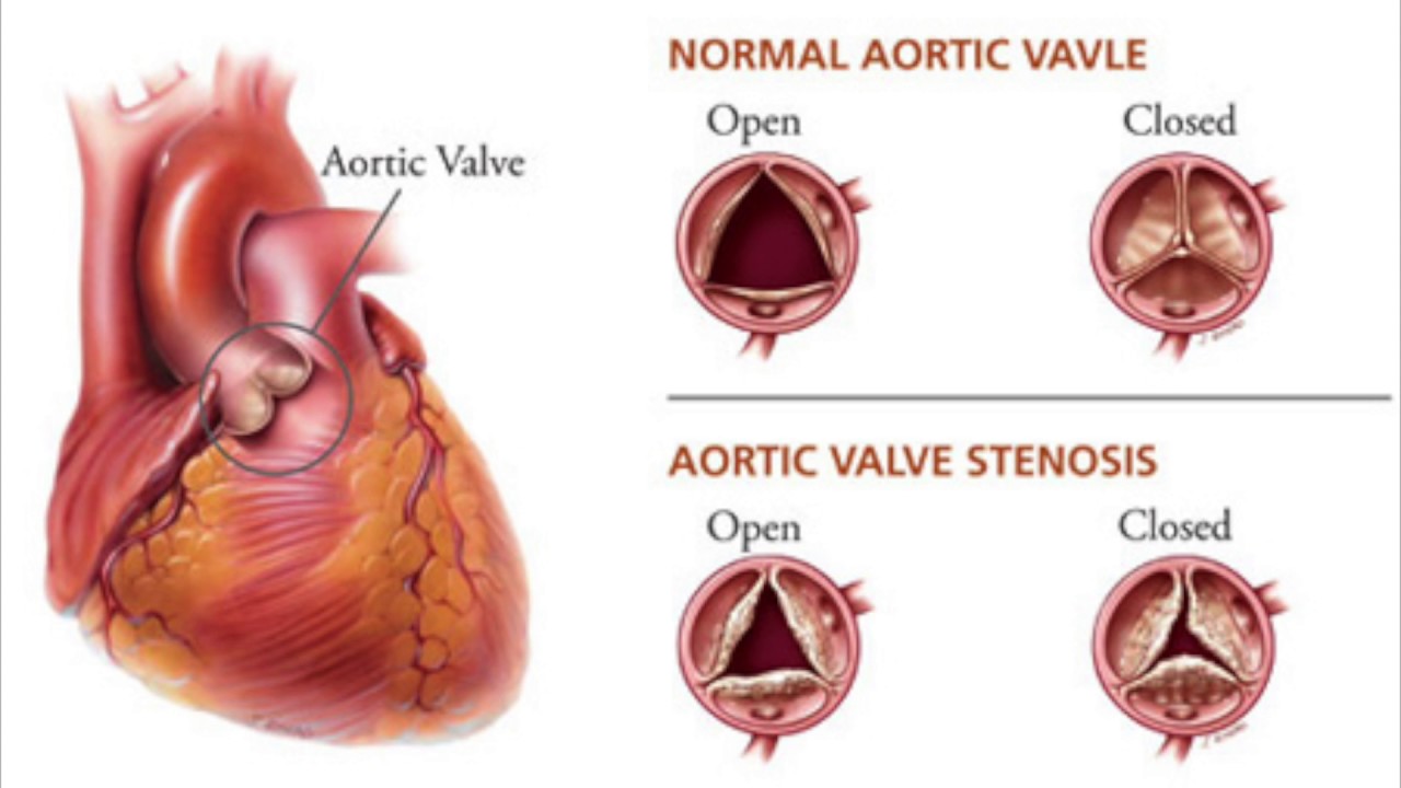 Heart Valves:  Pyrolytic Carbons