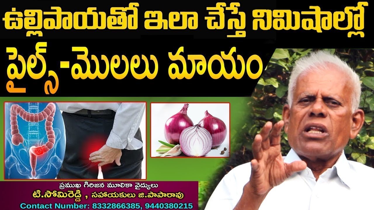 ఉల్లిపాయతో ఇలా చేస్తే పైల్స్ - మొలలు జన్మలో రావు | Home Remedies For Piles With Onion | Health Tips