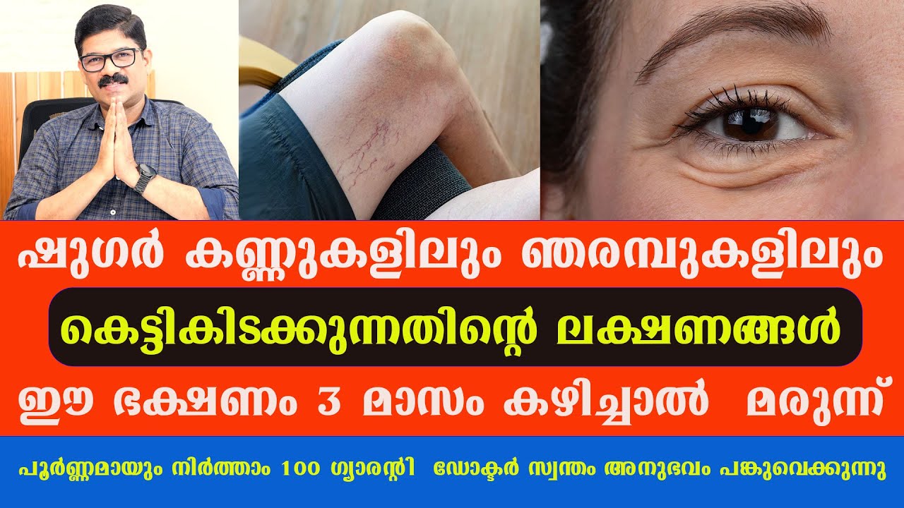 ഷുഗർ കണ്ണുകളിലും ഞരമ്പുകളിലും  കെട്ടികിടക്കുന്നതിന്റെ ലക്ഷണങ്ങൾ പരിഹാരം Dr Shimji / Suger Malayalam,