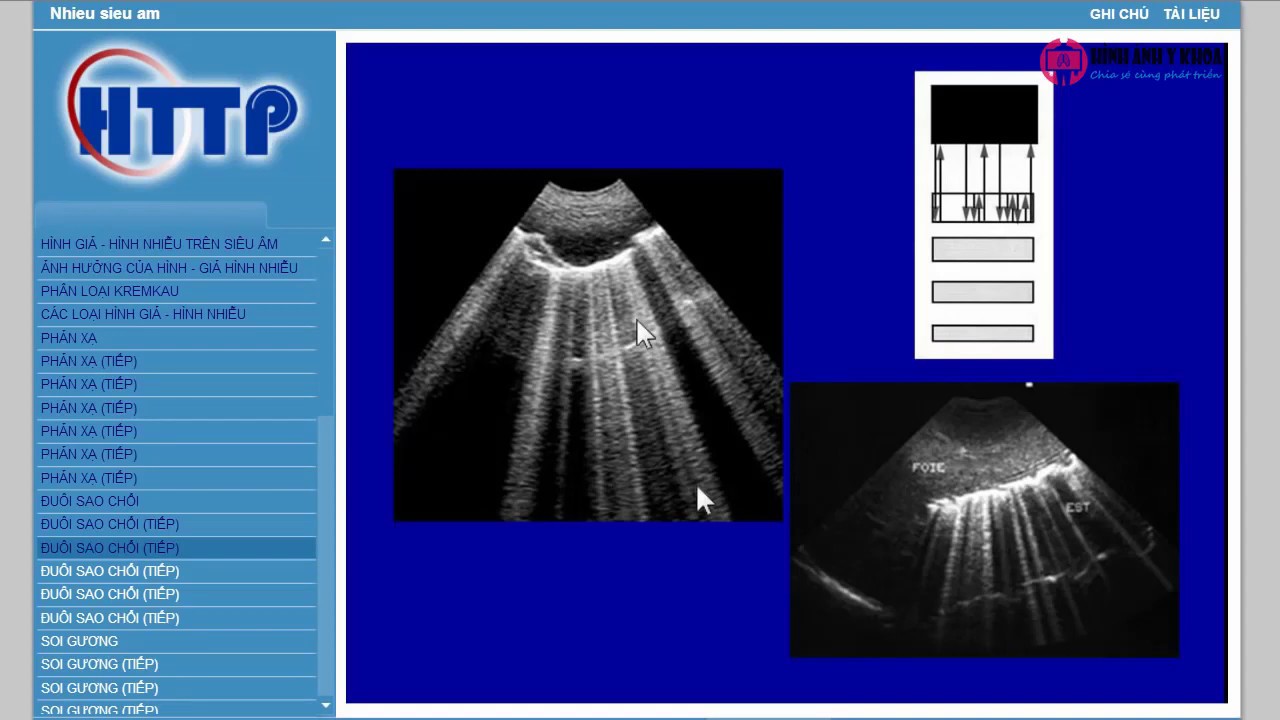 02. Hình ảnh giả, ảnh nhiễu siêu âm - TS. Phạm Hồng Đức (SIÊU ÂM TỔNG QUÁT BỆNH VIỆN BẠCH MAI)