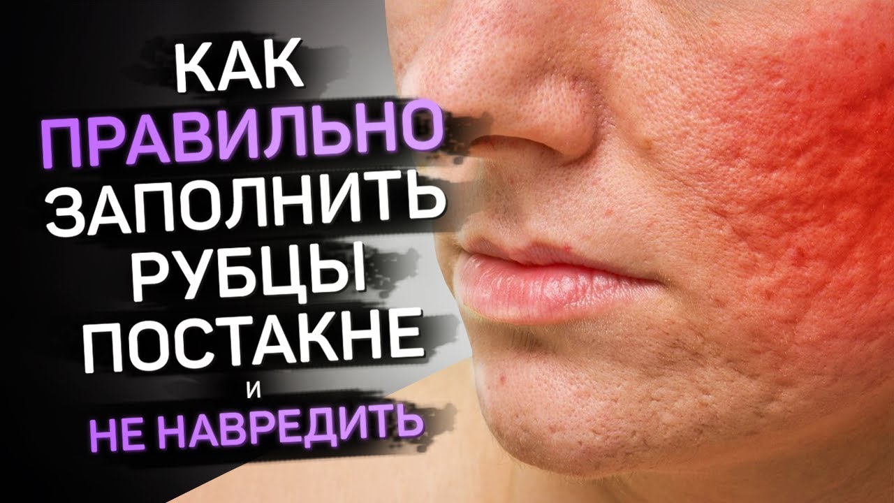 Заполняем рубцы постакне