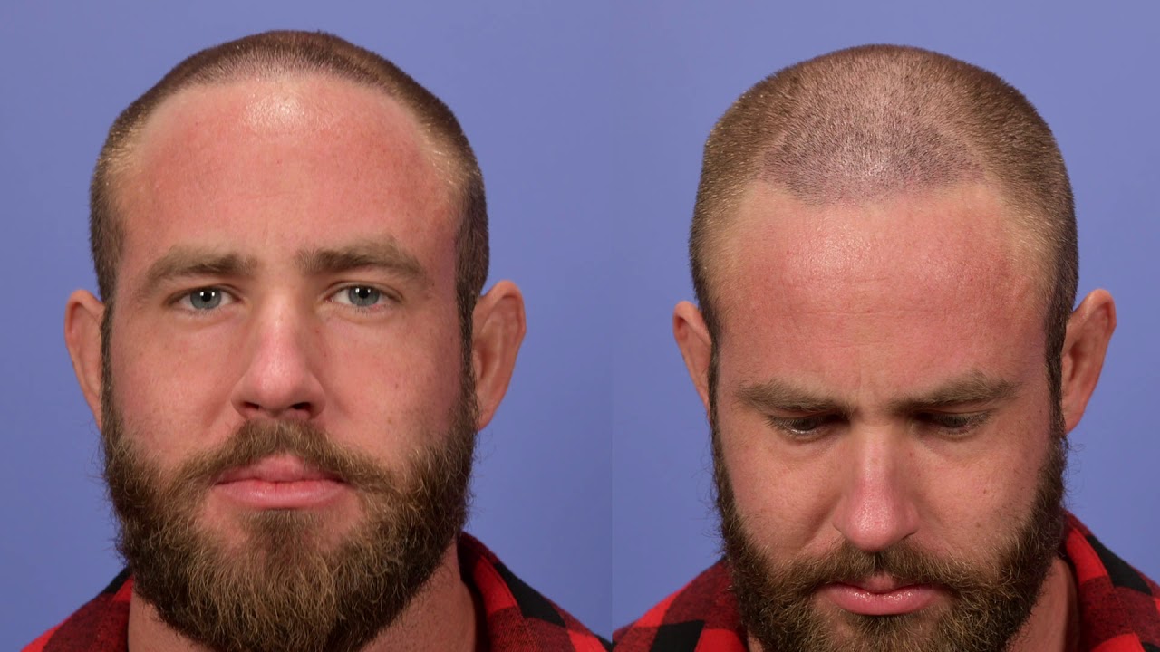 FUE Hair Transplant Review Pt 3 | Gabel Center | Portland, OR